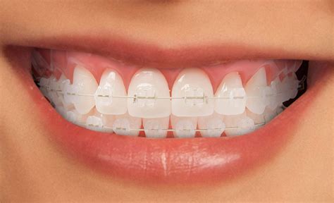 brackets de porcelana vs metal|Brackets de cerámica .